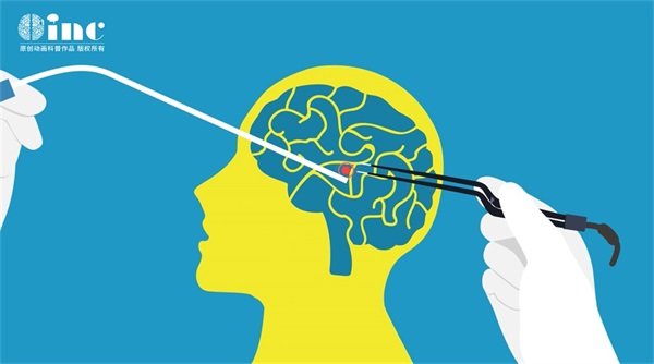 室管膜瘤第二期症状、病因与治疗