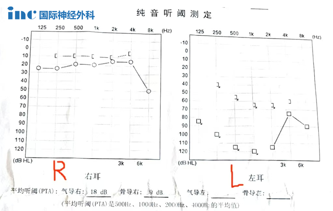 颈静脉孔区脑膜瘤