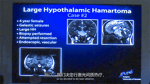 James T. Rutka教授曾通过LITT治疗过一位四岁的下丘脑错构瘤癫痫患儿