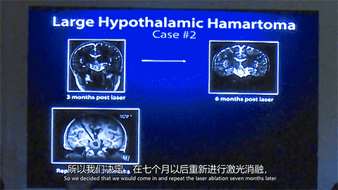 James T. Rutka教授曾通过LITT治疗过一位四岁的下丘脑错构瘤癫痫患儿