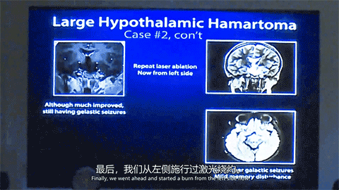 James T. Rutka教授曾通过LITT治疗过一位四岁的下丘脑错构瘤癫痫患儿