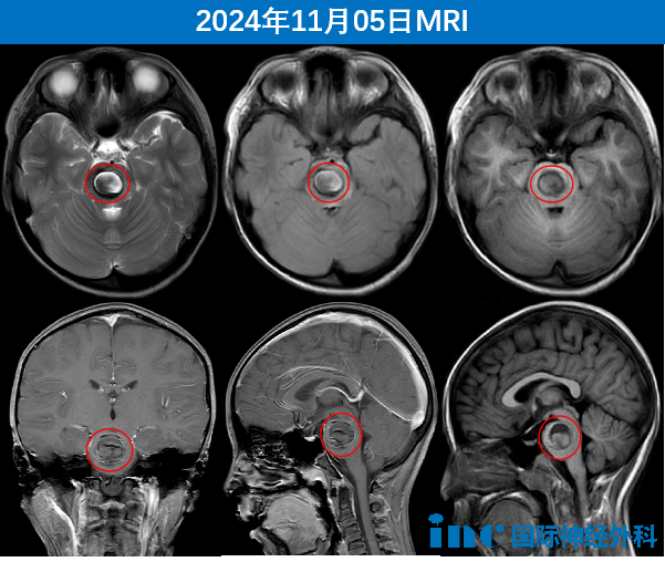 这“神”来之术  开颅术后当天竟未进ICU——儿童疑难<a href='/naoliu/' target='_blank'><u>脑瘤</u></a>示范手术顺利进行！