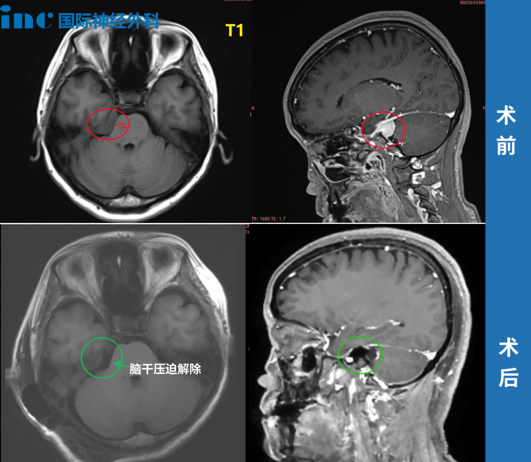 ▼术前术后MRI对比
