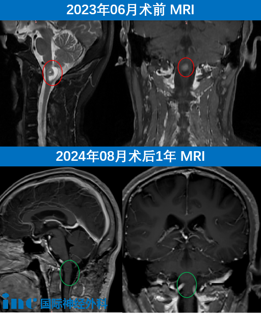 巴教授再次为林先生随访，“手术结果非常理想，患者能够对此感到高兴。我并不支持在完全切除肿瘤的情况下例行进行放疗，只需每年进行一次 MRI 复查——我认为其它的没必要。”