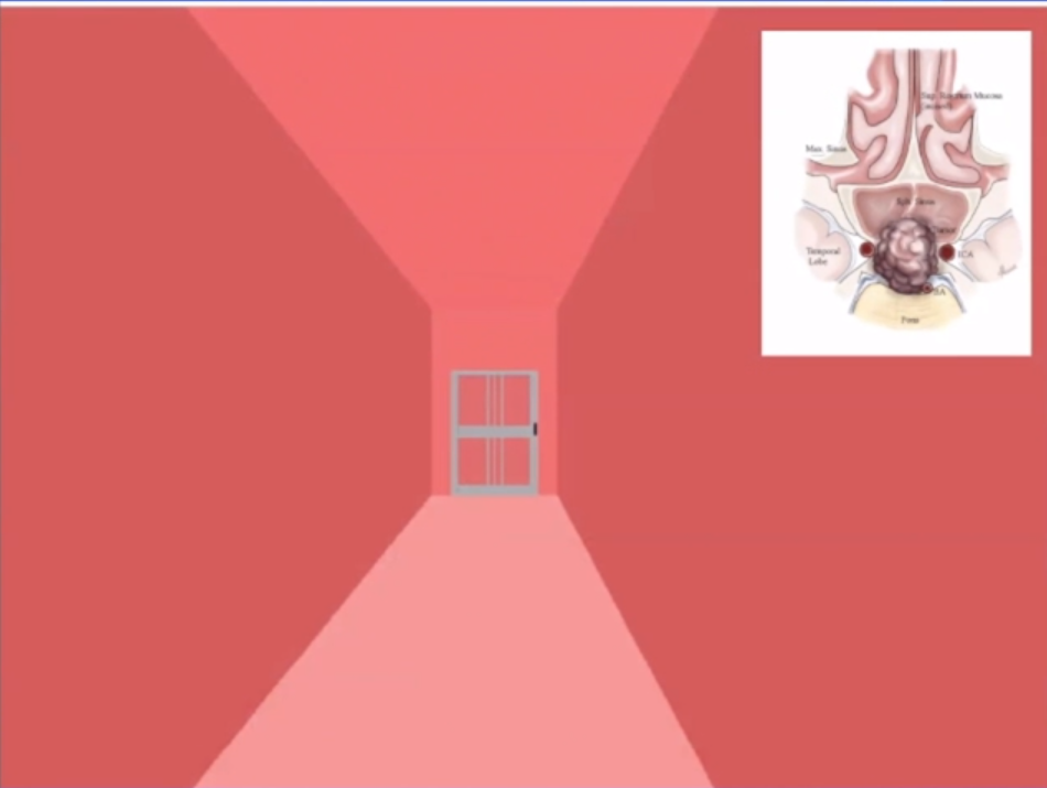 这是我经常使用的一个概念性图示，其中的“门”类似于蝶窦的前壁，是我们希望打开的目标位置，以便进入蝶窦腔内。