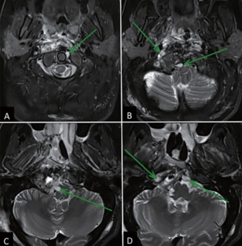 内镜下经鼻肿瘤切除术后(第一阶段)的影像学检查结果。MRI T2加权成像显示脑干得到充分减压;正中中线部分肿瘤切除，其他在枢椎齿状突、C1侧方和硬膜内残留肿瘤等待第二阶段开颅手术切除(绿色箭头)。
