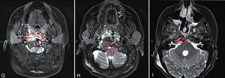 MRI T2加权成像显示内镜辅助执行的手术区域。在内镜辅助下，成功地切除了枢椎齿状突(G中的红色圆圈)、颅颈交界处(H中的红色圆圈)和中斜坡区(I中的红色圆圈)的肿瘤。