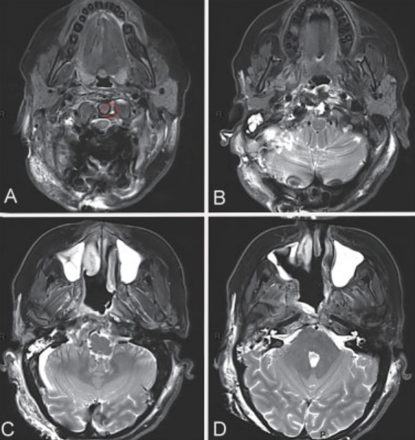 第二阶段远外侧入路开颅手术后的术后影像学检查结果。MRI T2加权成像显示通过分期手术实现了脊索瘤的次全切除。在齿状突周围区域检测到一小块残留肿瘤(A中的红色圆圈所示)。