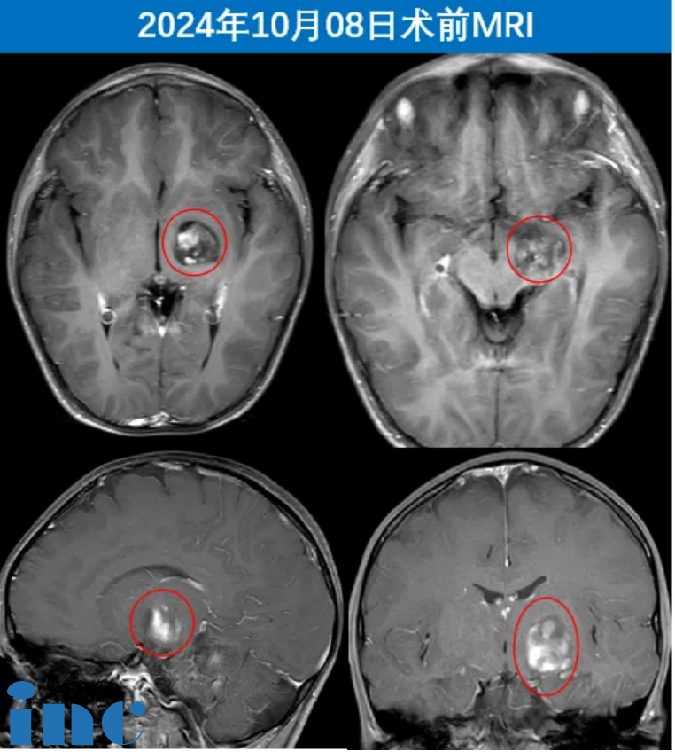术前MRI