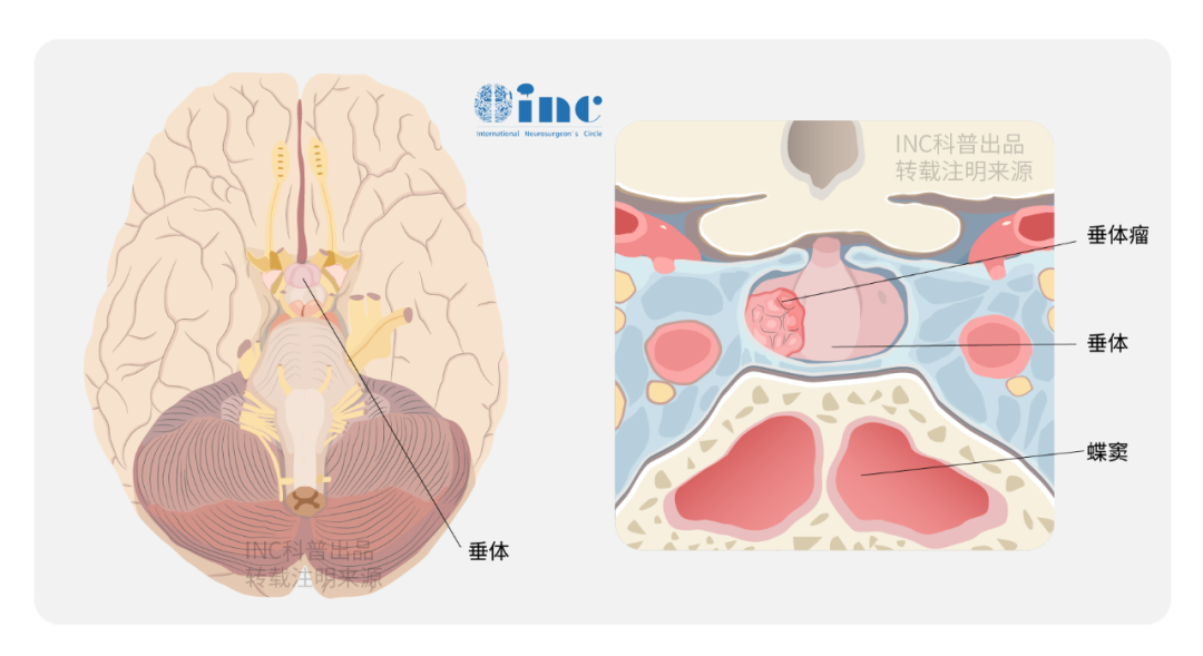 巨大垂体腺瘤手术难点