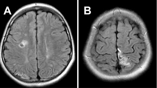 图A&B：患者初次就诊时进行的 FLAIR MRI，显示 MMD 引起的双侧脑梗死。