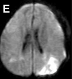 图E：左侧联合搭桥手术后进行的弥散加权 MRI 显示远离搭桥的区域发生意外脑梗死。