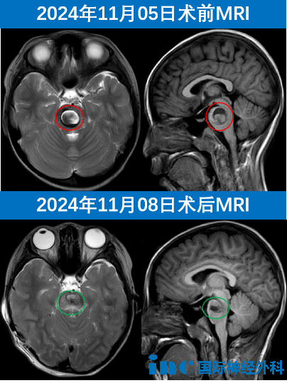 MRI