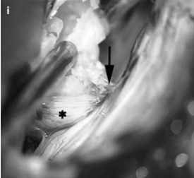 箭头指向进入颈静脉孔的肿瘤部分(i)