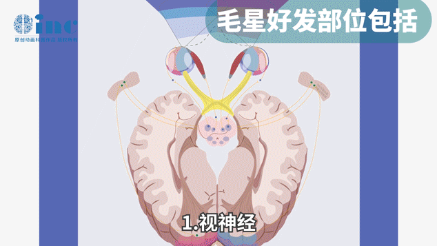 良性低级别胶质瘤（pediatric low-grade glioma, PLGG）