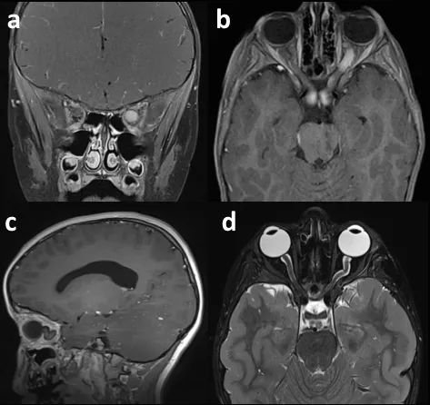 视神经胶质瘤 MRI