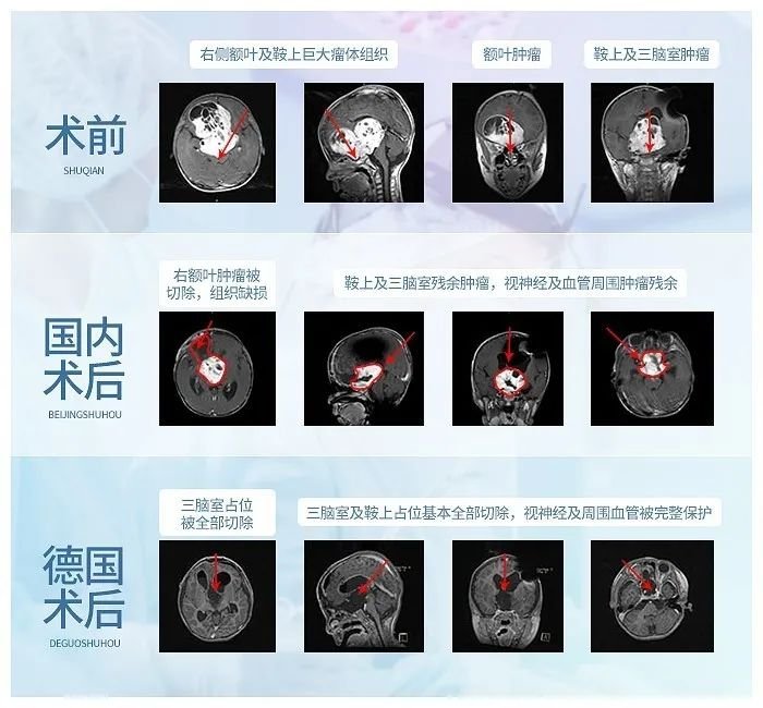 INC国际巴教授近全切肿瘤