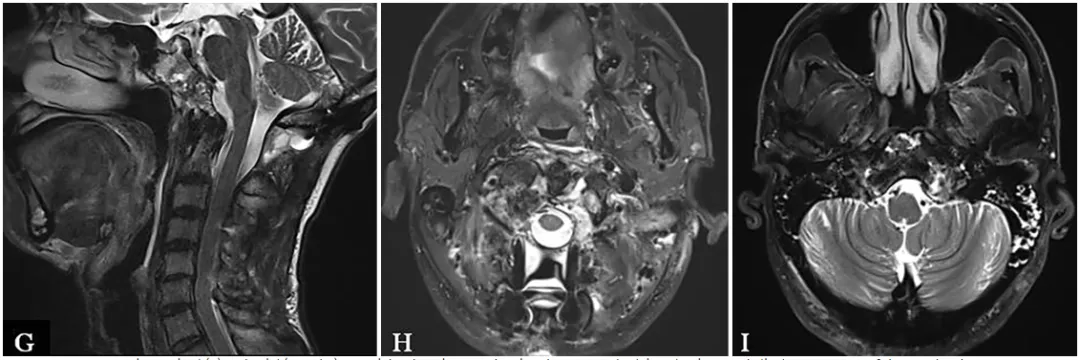 该患者术后 MRI，显示近全切除(NTR)。
