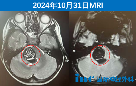 MRI影像