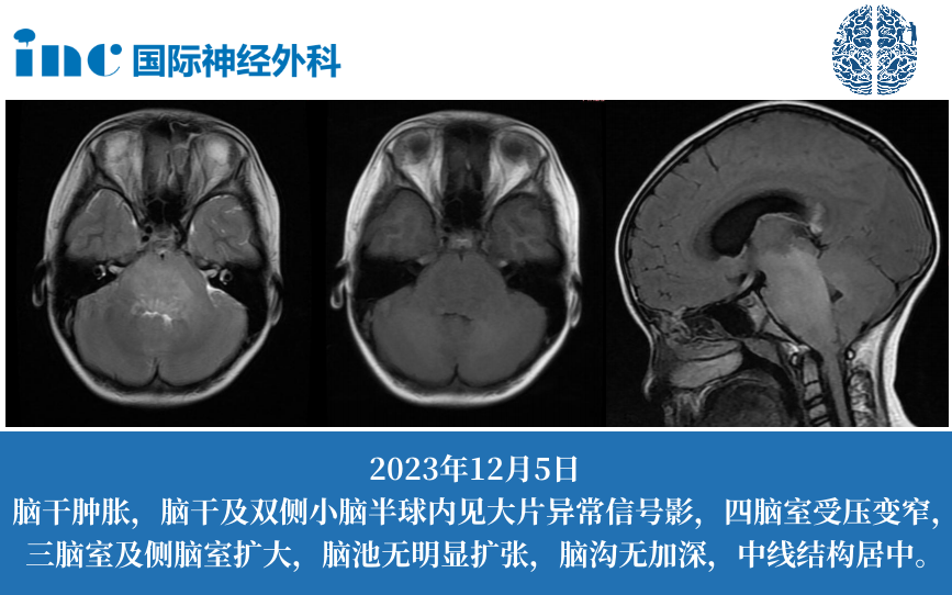 MRI影像