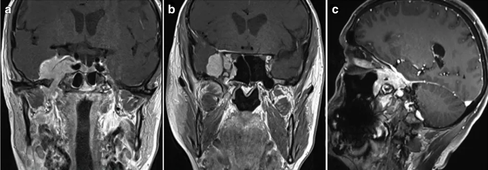 该患者术前磁共振成像(MRI)图像。在其右侧海绵窦区有一病变，且向颞窝、蝶鞍上区(SOF)、翼腭窝(FR)、眶上裂(FO)、翼腭缝(PPF)、岩斜区(ITF)及蝶鞍区(SphS)扩展。