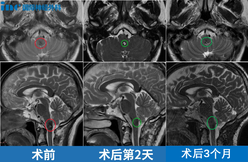 术前术后MRI影像