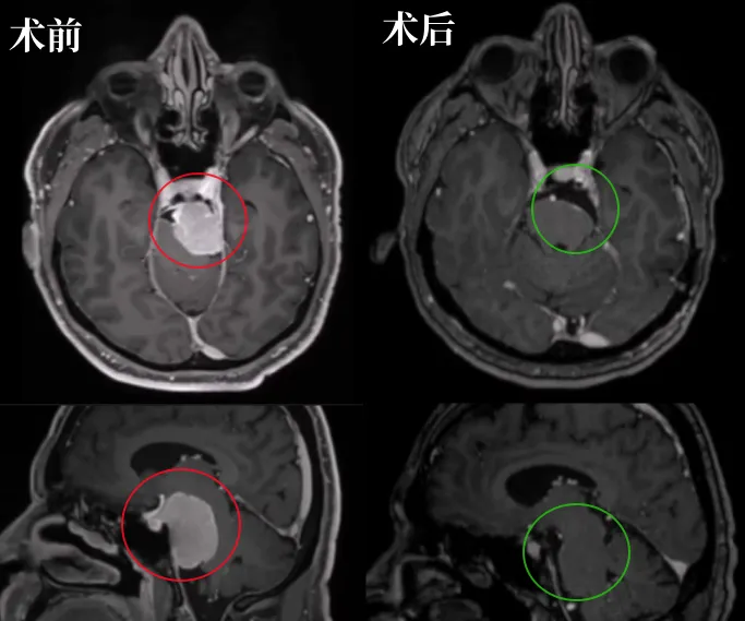 术前术后MRI影像