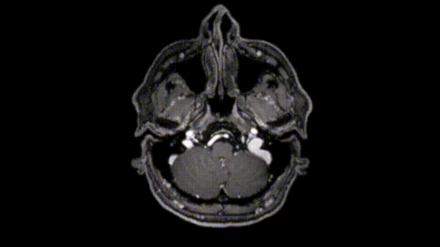 该患者2014年的磁共振成像(MRI)检查结果