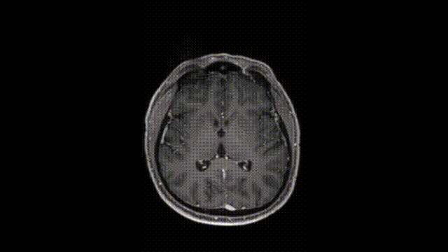 该患者2019年的磁共振成像(MRI)检查结果