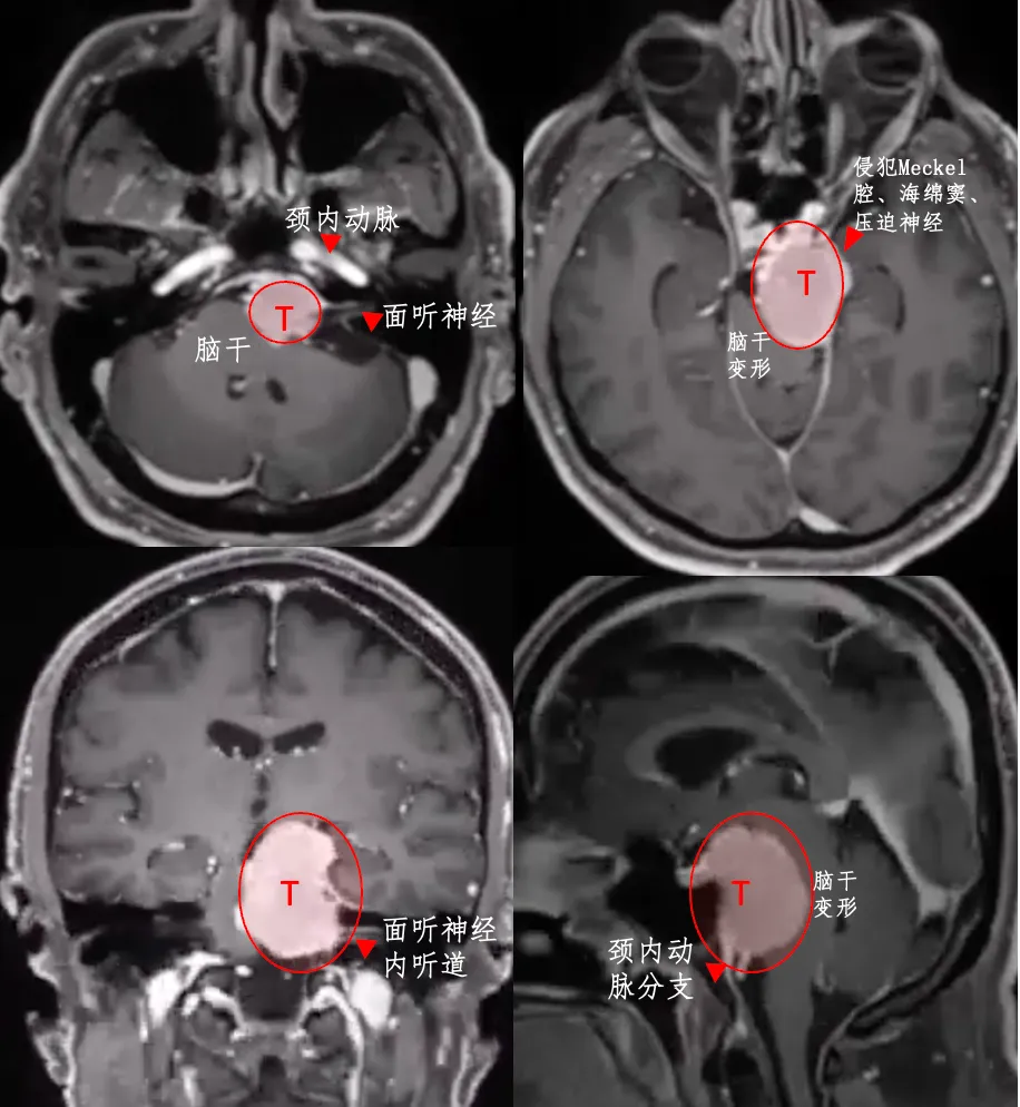 在侵袭前颅窝、中颅窝和后颅窝的情况下，岩斜区脑膜瘤的手术难度较大，