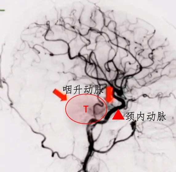 该肿瘤周围环绕有丰富的血管结构，主要包括咽升动脉以及颈内动脉硬脑膜分支。在手术过程中，这些血管容易受到损伤，从而导致出血。