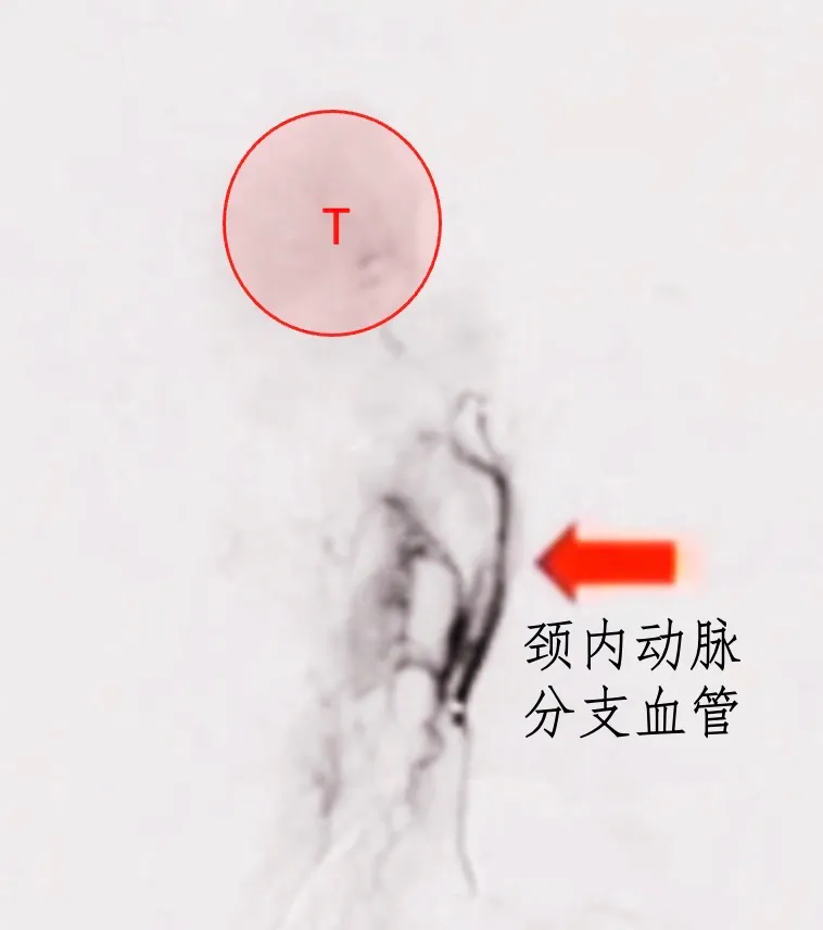 该肿瘤周围环绕有丰富的血管结构，主要包括咽升动脉以及颈内动脉硬脑膜分支。在手术过程中，这些血管容易受到损伤，从而导致出血。