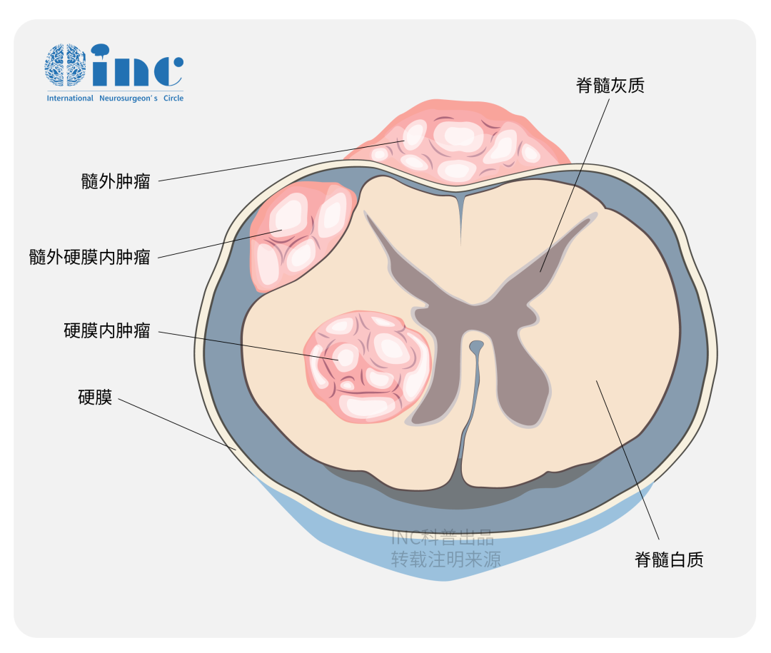脊柱肿瘤可以从椎骨开始（硬膜外肿瘤），也可以位于脑膜内（硬膜内肿瘤）。硬膜内肿瘤可分为脊髓肿瘤（髓内肿瘤）和不起源于脊髓的髓外肿瘤。