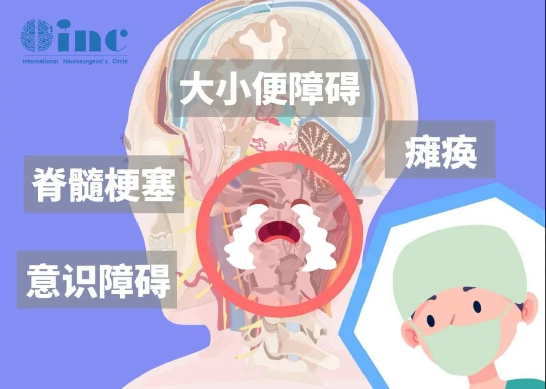 脊髓肿瘤常见症状