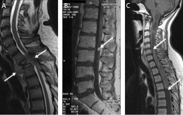 图1：脊柱肿瘤的 MRI 图像(箭头)A，第三胸椎水平的肾癌椎体转移，脊髓受到严重压迫;B，硬膜内上皮瘤;C，C5 - T4广泛髓内上皮瘤。
