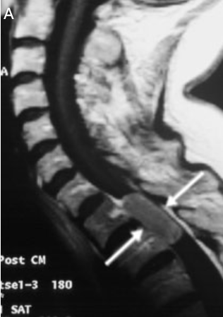 图4A：MRI 显示造影剂增强的肿瘤（箭头）几乎完全堵塞了脊髓管。