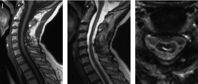 图7I：手术 4 年后的 MRI 图像显示肿瘤已完全切除。除左手精细运动障碍外，患者无其他不适。