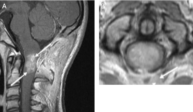 图8：A，MRI（箭头）。B，箭头所指为肿瘤周围剩余的正常脊髓组织（苍白肿瘤周围的灰色边缘）。