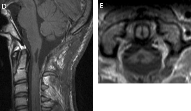 图8D&E：术后 3 个月的随访 MRI 显示肿瘤已完全切除。除了右手有轻微的笨拙外，患者的神经功能正常。