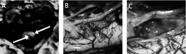 图9：A，MRI（箭头）。B，打开脑膜后，在第二颈神经根水平的脊髓外侧可见淡黄色变色。C，海绵瘤切除后的切口洞穴。
