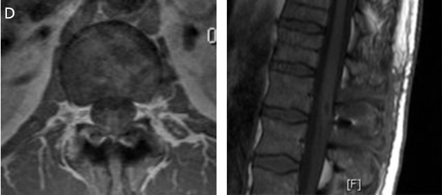 图10D：手术 3 个月后的随访 MRI 显示肿瘤已完全切除，囊肿已塌陷，障碍完全消除。