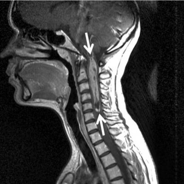 图11：患者术前MRI。