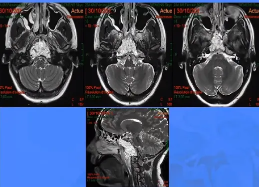 图示为患者术后进行的磁共振成像（MRI）扫描，高信号区域代表脂肪组织。福教授认为，采用内镜技术抵达颅颈交界区更为简便。