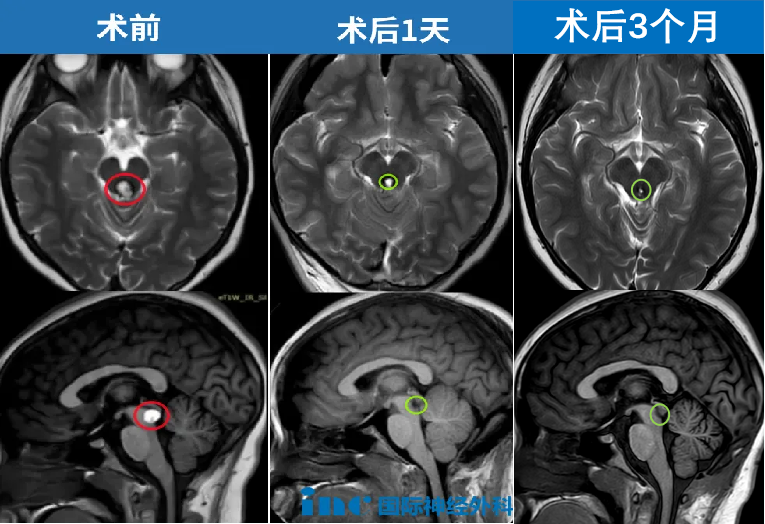 MRI影像