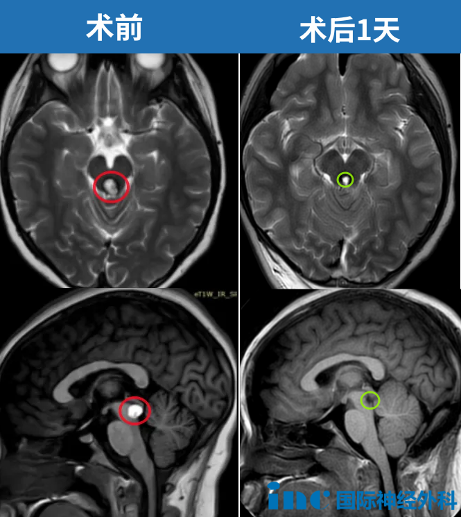 术前术后影像