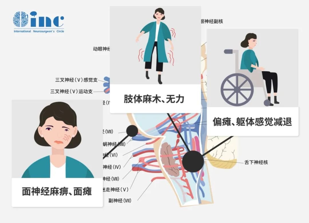 神经功能损伤