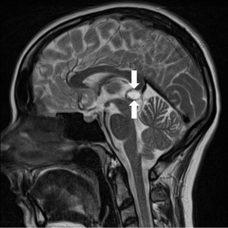 图4：术前MRI