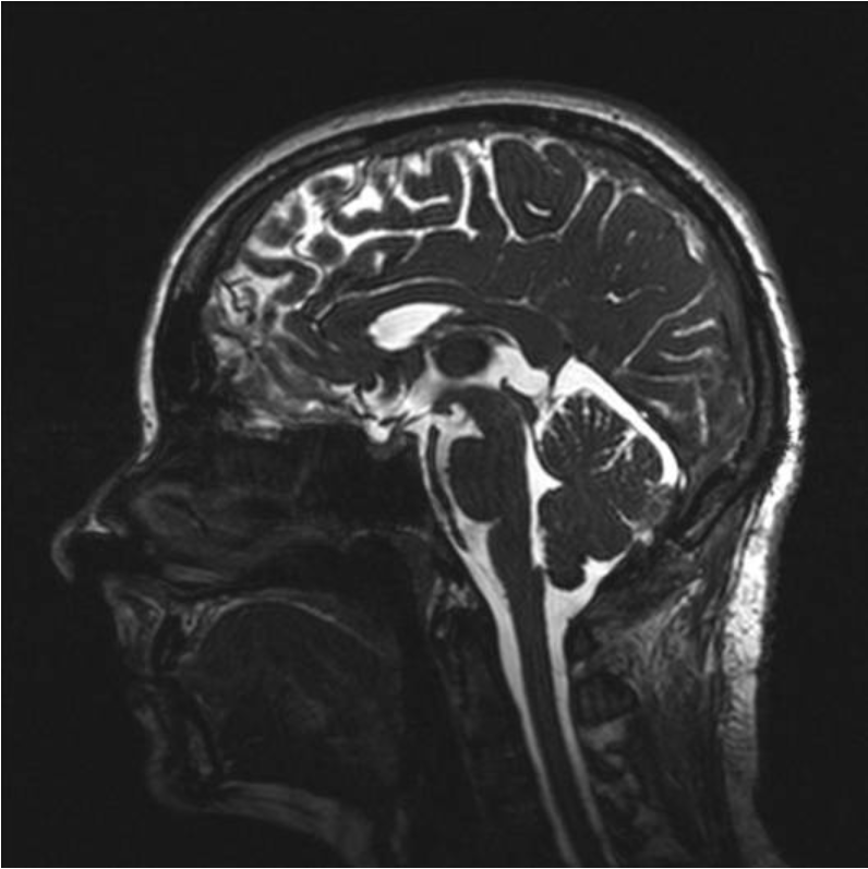 图5：术后MRI