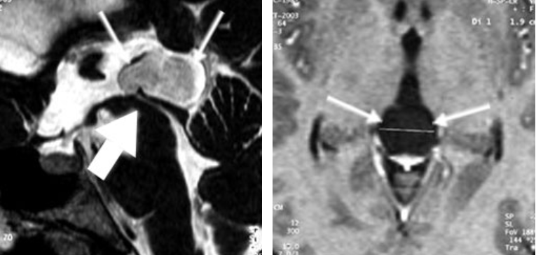 图6：松果体囊肿的 MRI(矢状切面和轴切面)。可以看到导水管(粗箭头)被囊肿(细箭头)移位。
