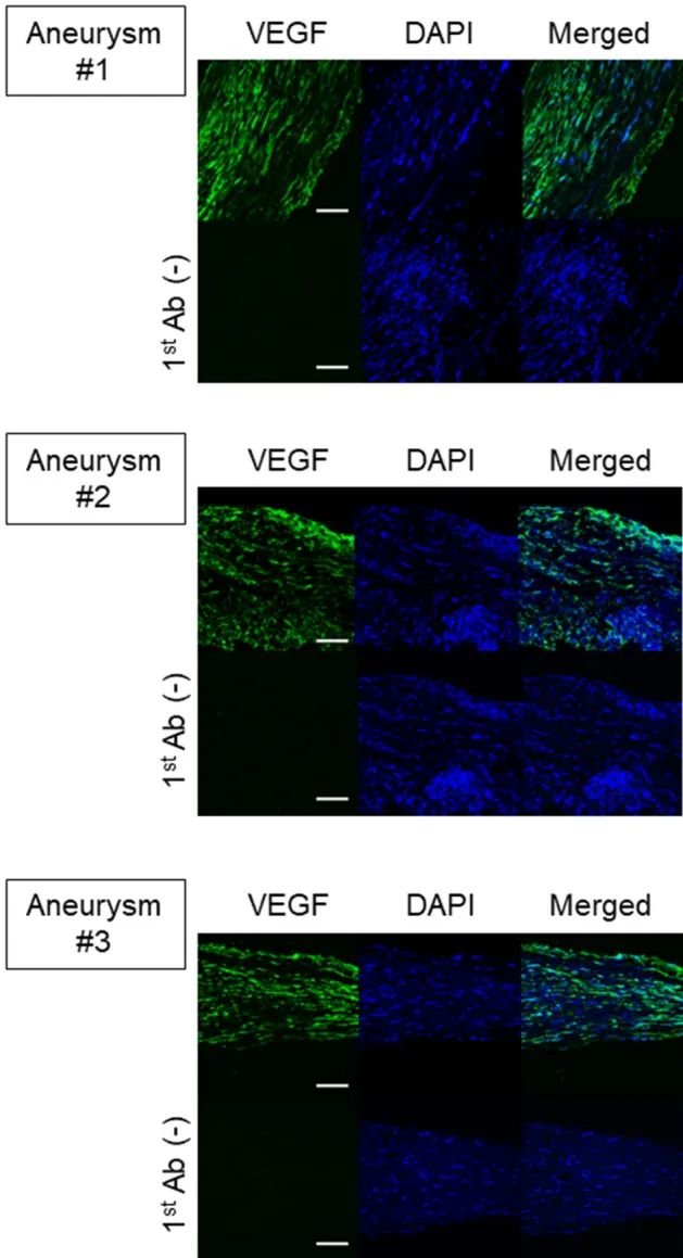 图3：VEGF 在人类未破裂颅内动脉瘤中的表达。显示了 VEGF (绿色) 、 DAPI 核染色 (蓝色) 和合并图像的脑动脉瘤病灶免疫荧光染色的图像。